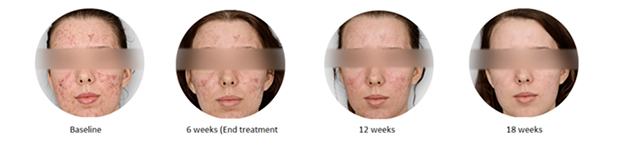 Types of Acne Scars
